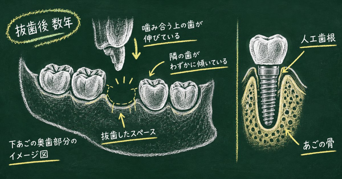 奥歯を抜歯後数年放置してしまった方へ、人工歯根は今から検討できる?