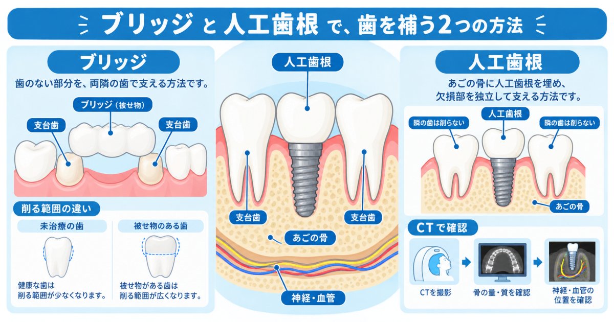ブリッジで隣の歯を削る量と人工歯根との違い、残る歯の寿命を守る選び方