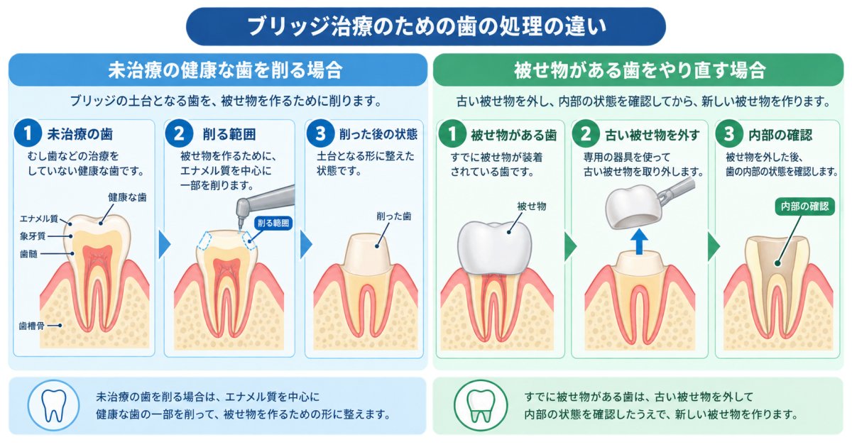 ブリッジで隣の歯を削る量は、未治療の歯か被せ物のある歯かで変わる