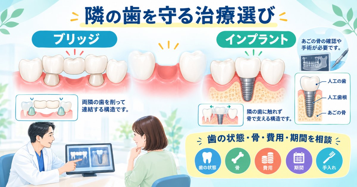 ブリッジで隣の歯を削る量と人工歯根との違い、残る歯の寿命を守る選び方
